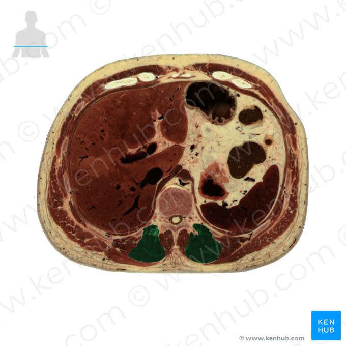 Musculus longissimus thoracis (Brustteil des langen Rückenmuskels); Bild: National Library of Medicine