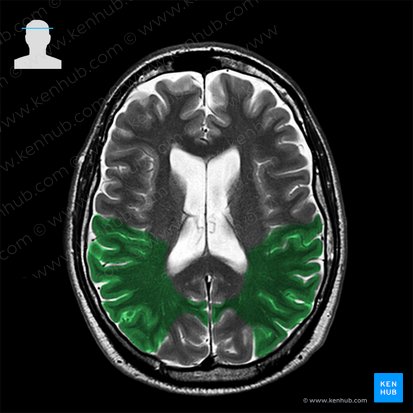 Parietal lobe (Lobus parietalis); Image: 