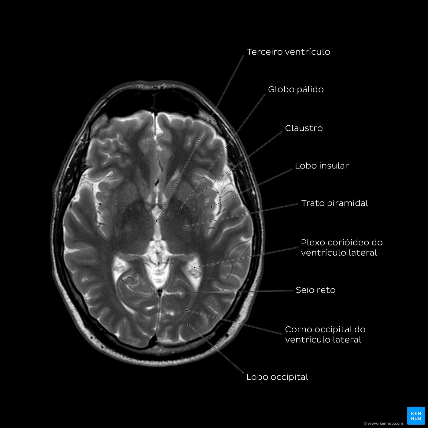 Esquema de RM do cérebro em T2 ao nível dos núcleos caudados
