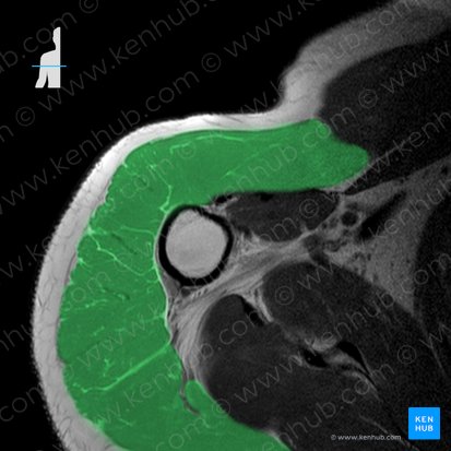 Musculus deltoideus (Deltamuskel); Bild: 