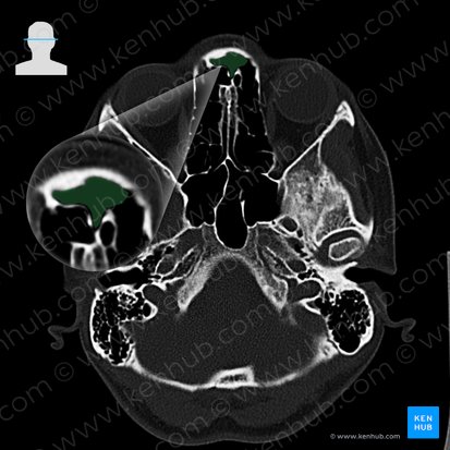 Frontal sinus (Sinus frontalis); Image: 