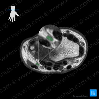 Ulnar nerve (Nervus ulnaris); Image: 