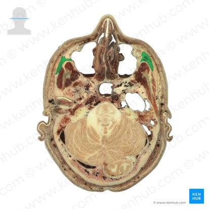 Os zygomaticum (Jochbein); Bild: National Library of Medicine