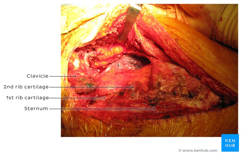 Partial thoracotomy repair