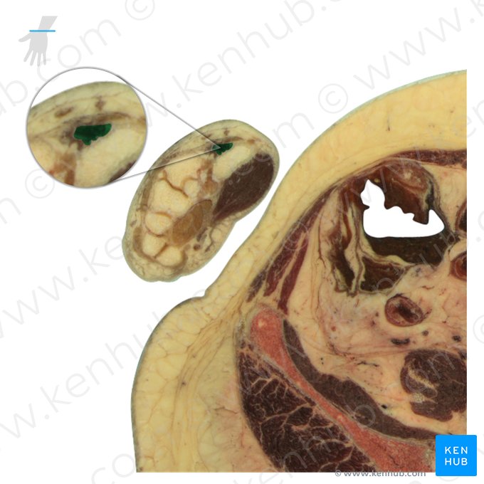 Musculus interosseus dorsalis 1 manus (1. rückseitiger Zwischenknochenmuskel); Bild: National Library of Medicine