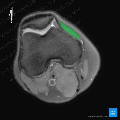 Vastus medialis muscle (Musculus vastus medialis); Image: 