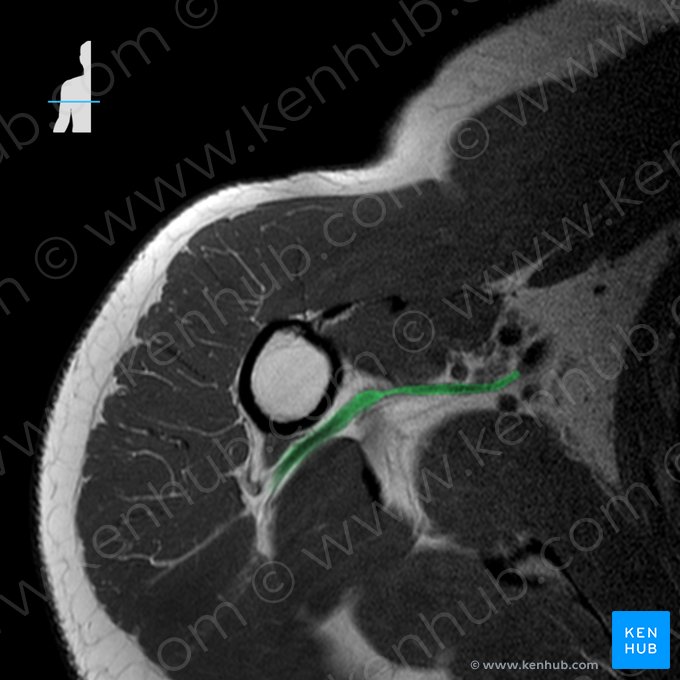 Arteria circumflexa posterior humeri (Hintere Oberarmkranzarterie); Bild: 