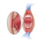 Pterygomandibular raphe