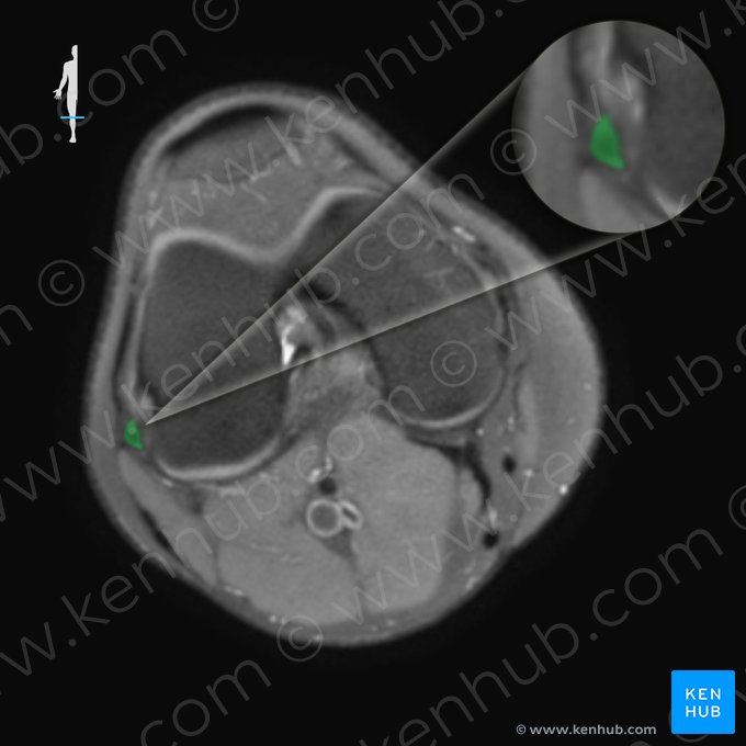 Ligamento colateral fibular do joelho (Ligamentum collaterale fibulare genus); Imagem: 