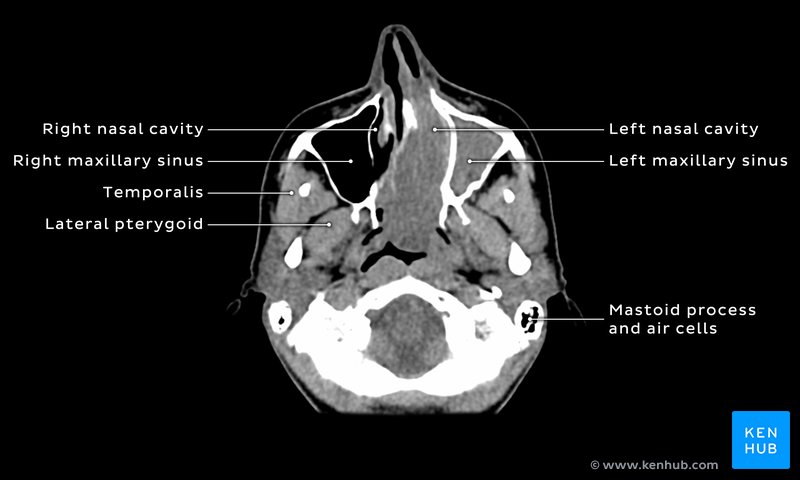 Opacification of left nasal cavity, nasopharynx and maxillary sinus - axial CT