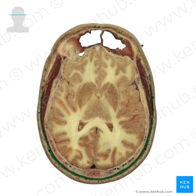 Epicranial aponeurosis (Galea aponeurotica); Image: National Library of Medicine