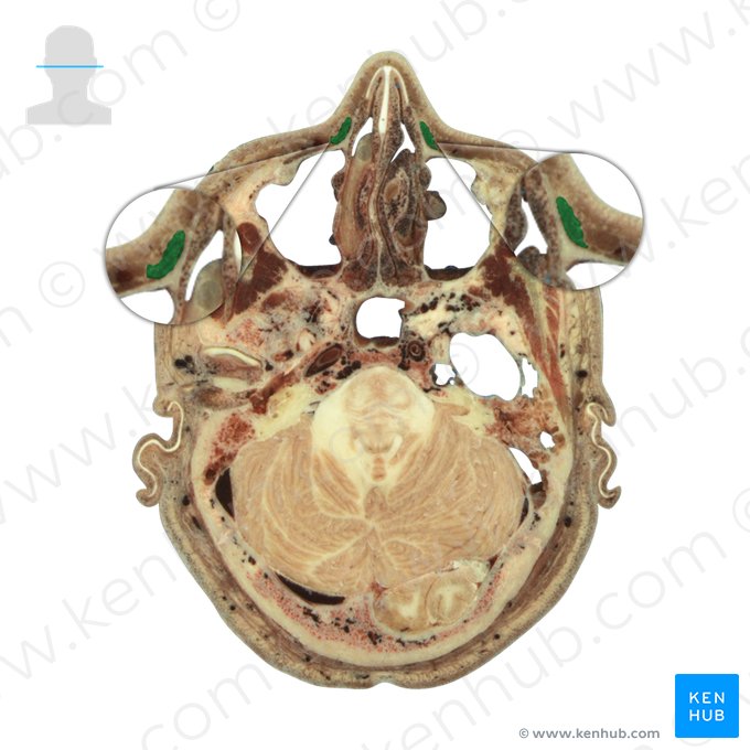 Musculus levator labii superioris alaeque nasi (Oberlippen- und Nasenflügelheber); Bild: National Library of Medicine