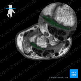 Palmar ulnocarpal ligament (Ligamentum ulnocarpeum palmare); Image: 