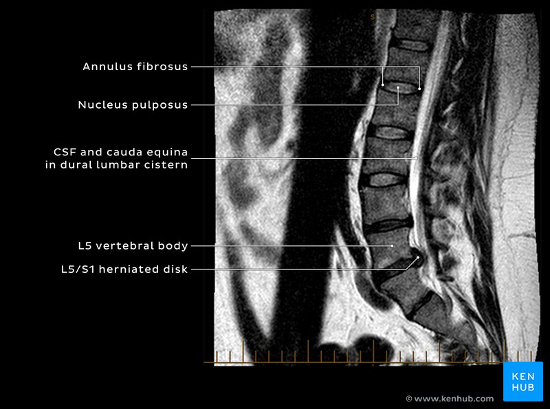 Sagittal T2 MRI