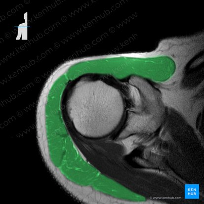 Musculus deltoideus (Deltamuskel); Bild: 