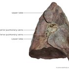 Clinical case: Incidental pneumonectomy