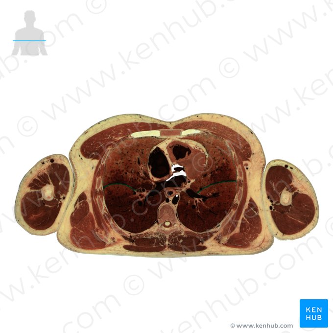 Fissura oblíqua do pulmão (Fissura obliqua pulmonis); Imagem: National Library of Medicine