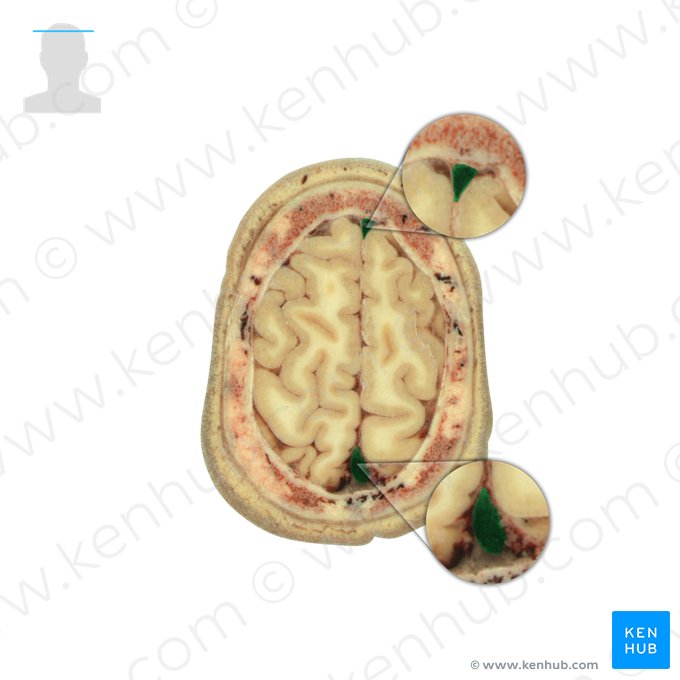 Sinus sagittalis superior (Oberer Pfeilblutleiter); Bild: National Library of Medicine