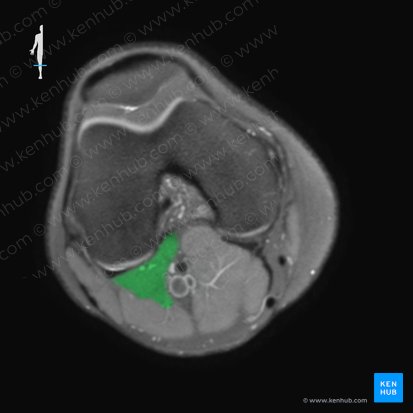 Musculus plantaris (Fußsohlenmuskel); Bild: 