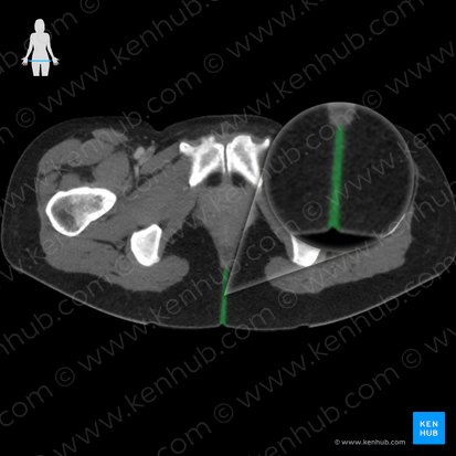 Intergluteal cleft (Crena interglutealis); Image: 