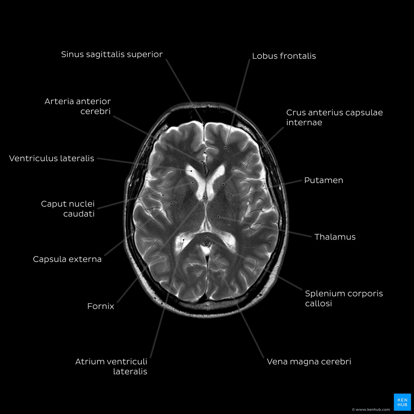 MRT des Gehirns, T2w - Höhe des Thalamus
