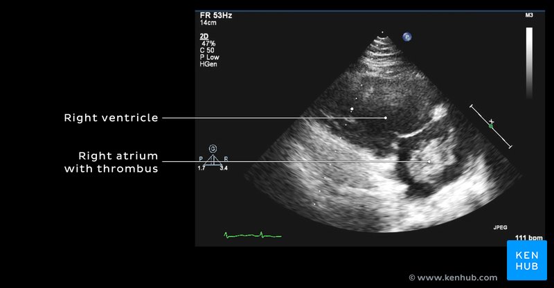 Echocardiogram showing atrial thrombus
