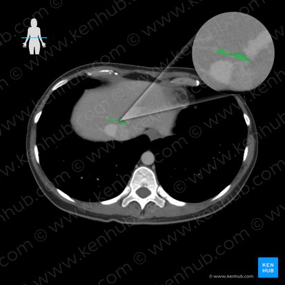 Intermediate hepatic vein (Vena hepatica intermedia); Image: 