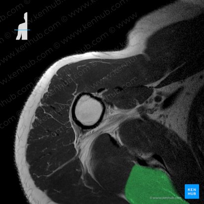 Musculus infraspinatus (Untergrätenmuskel); Bild: 