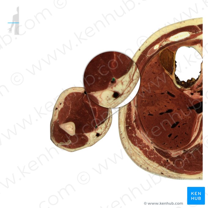 Artéria braquial (Arteria brachialis); Imagem: National Library of Medicine