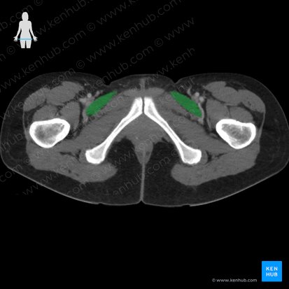 Pectineus muscle (Musculus pectineus); Image: 
