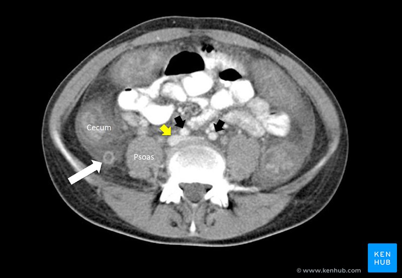Appendicitis with normal anatomy of cecum and appendix