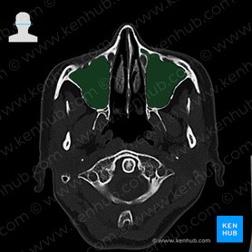 Seio maxilar (Sinus maxillaris); Imagem: 