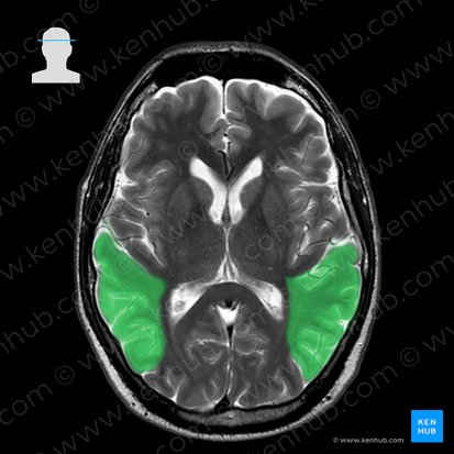 Temporal lobe (Lobus temporalis); Image: 