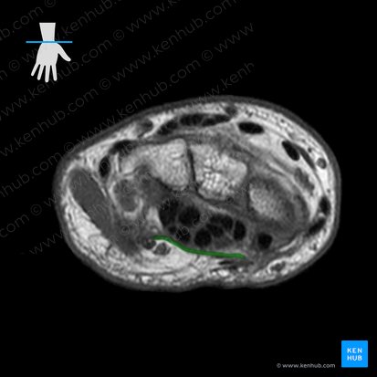 Retinaculum flexorum carpi (Karpalband); Bild: 