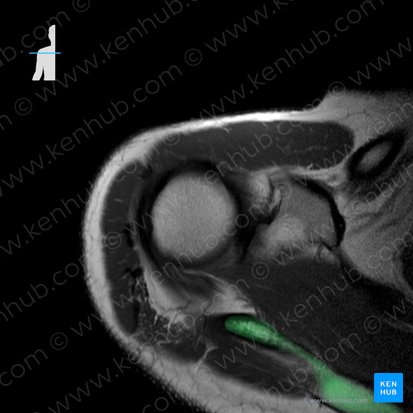 Espina de la escápula (Spina scapulae); Imagen: 