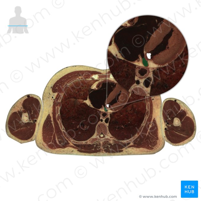 Coronary sinus (Sinus coronarius); Image: National Library of Medicine