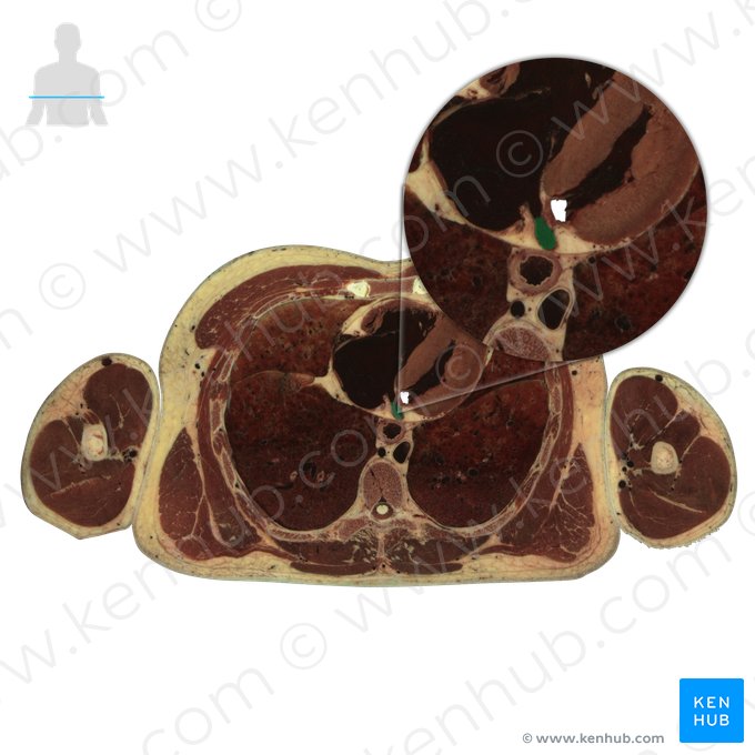 Seio coronário (Sinus coronarius); Imagem: National Library of Medicine