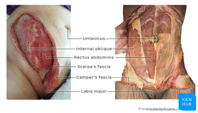 Nursing Paper Example on Necrotizing Fasciitis [SOLVED]