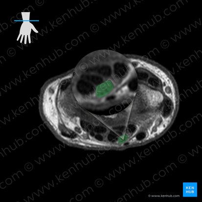 Median nerve (Nervus medianus); Image: 