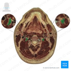 Longissimus cervicis muscle (Musculus longissimus cervicis); Image: National Library of Medicine