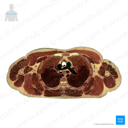 Pulmonary trunk (Truncus pulmonalis); Image: National Library of Medicine