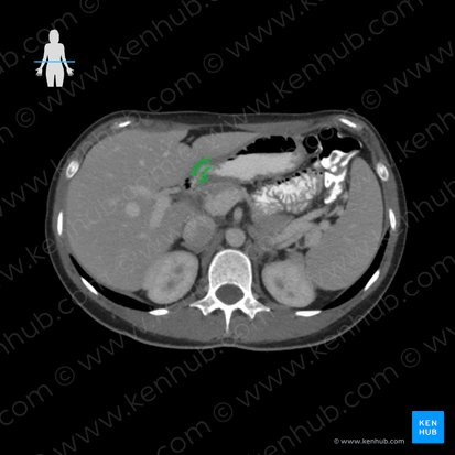 Pylorus; Image: 