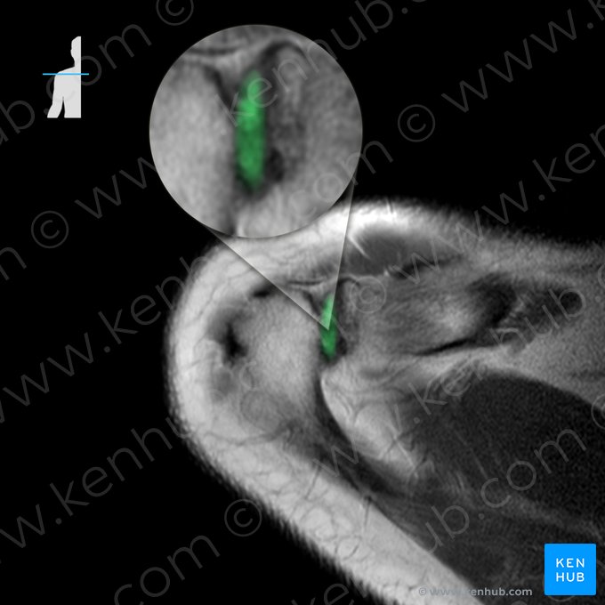 Articulação acrômio-clavicular (Articulatio acromioclavicularis); Imagem: 