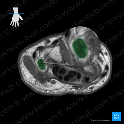 Ligamentum pisometacarpeum (Erbsenbein-Mittelhandknochen-Band); Bild: 