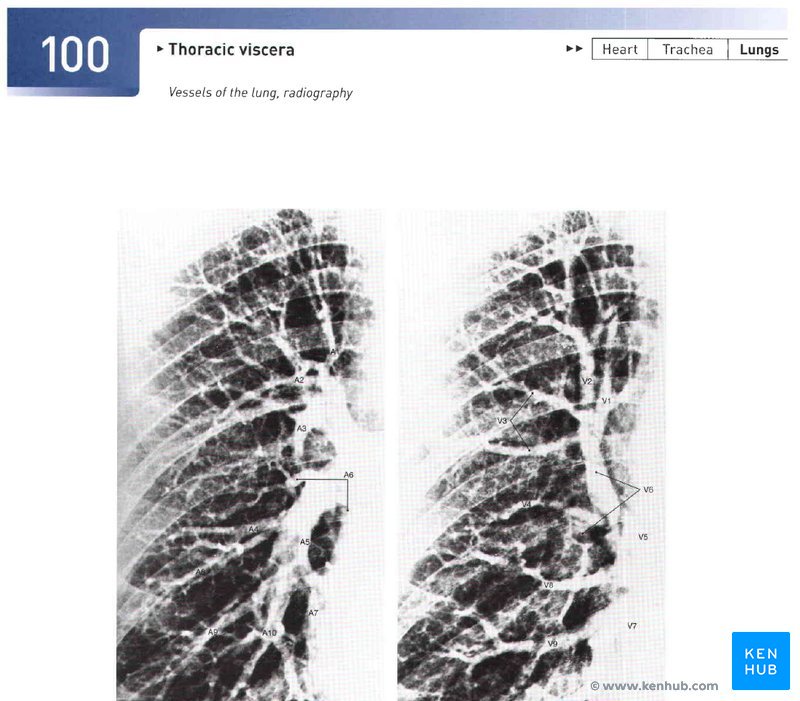 Sobotta Atlas de Anatomia Humana - radiografia dos vasos dos pulmões
