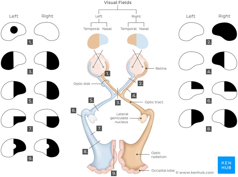 Visual field defects