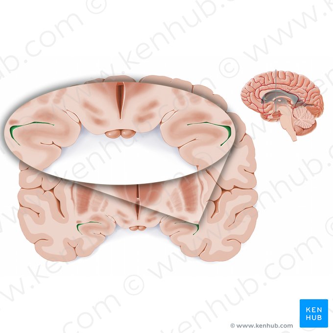 Corno temporal do ventrículo lateral (Cornu temporale ventriculi lateralis); Imagem: Paul Kim