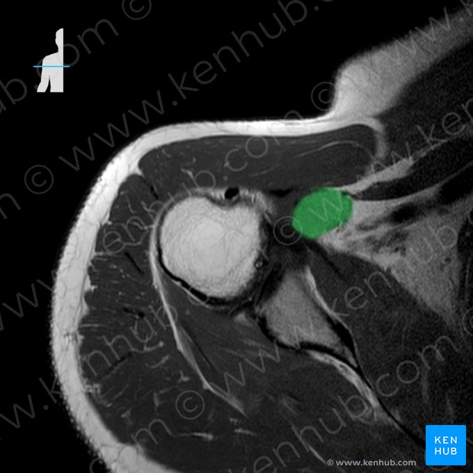 Musculus coracobrachialis (Rabenschnabel-Oberarmmuskel); Bild: 