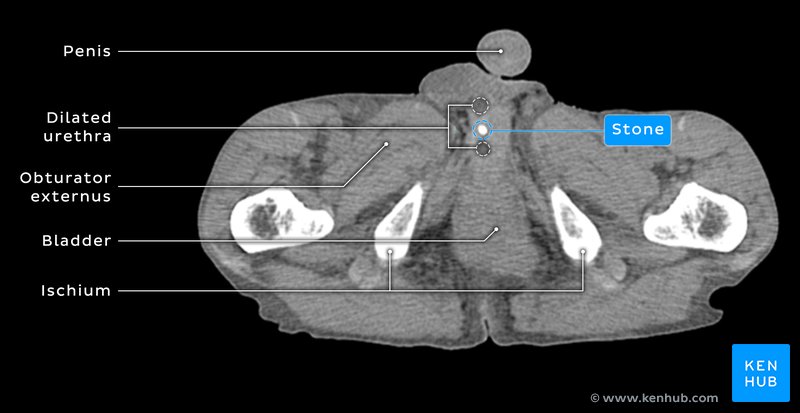 Urethral Stone - Axial CT