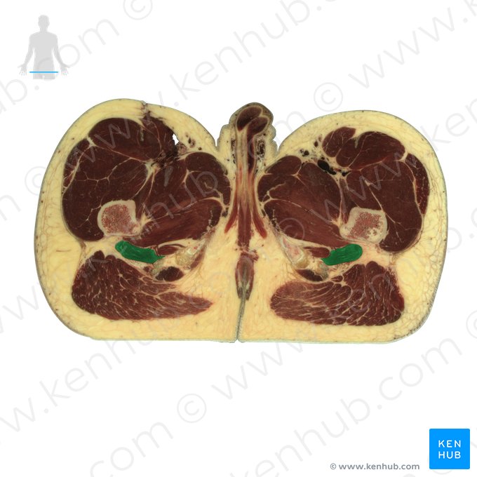 Quadratus femoris muscle (Musculus quadratus femoris); Image: National Library of Medicine